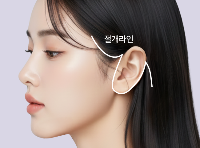 리팅 안면거상의 절개라인