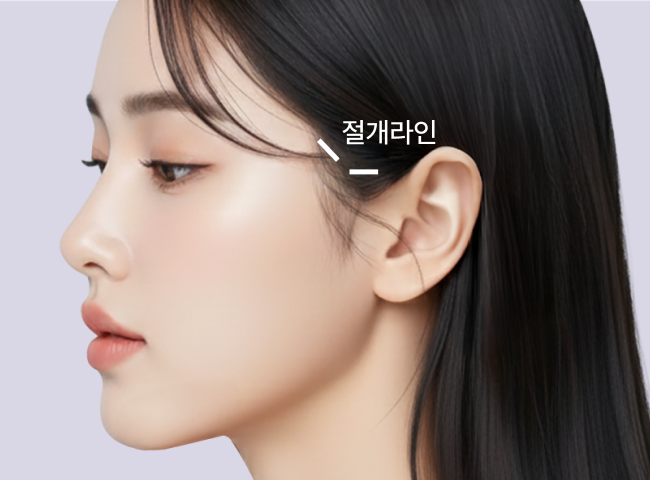 리팅 엘팅1 리프팅의 절개라인