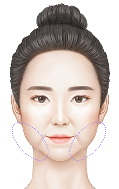 처짐 부위 2