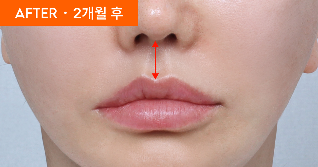 AFTER · 2개월 후