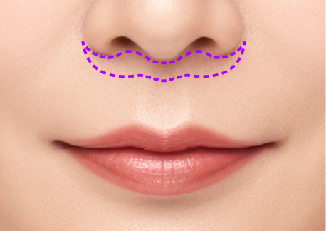 인중축소술 1단계