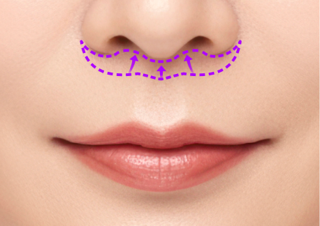 인중축소술 1단계