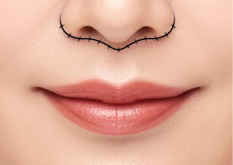 인중축소술 2단계 