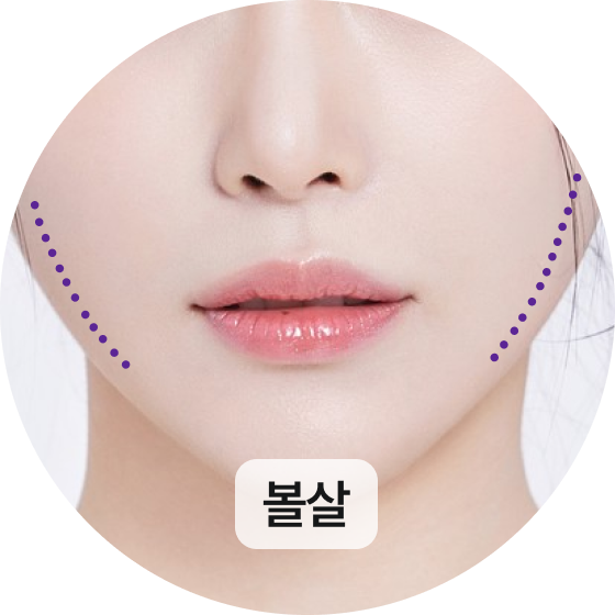 볼살