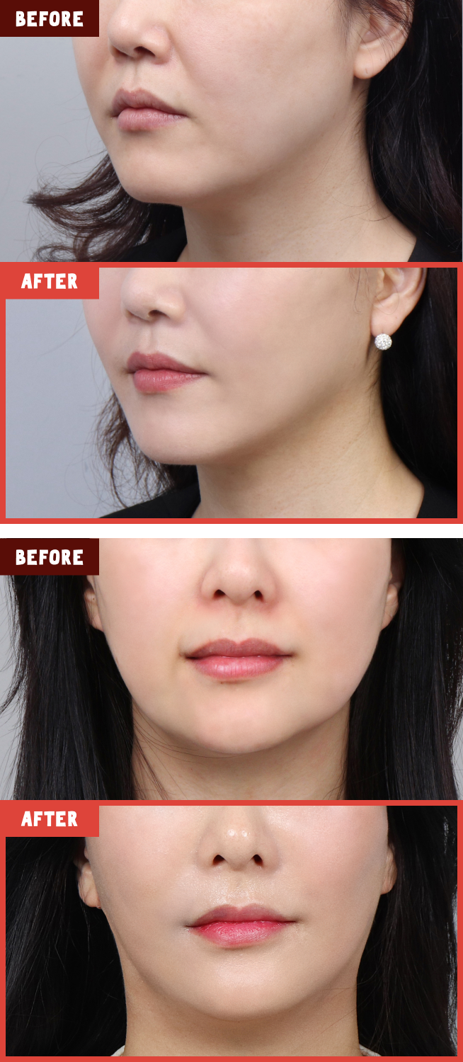 얼굴 전반의 윤곽선 정리가 필요한 경우