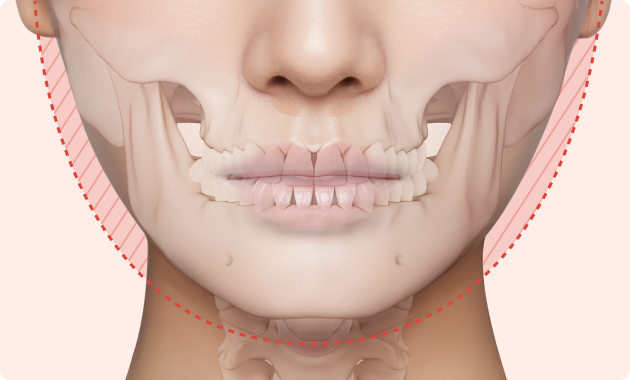 윤곽 수술, 반드시 뼈를 깎는 수술만이 답은 아닙니다.