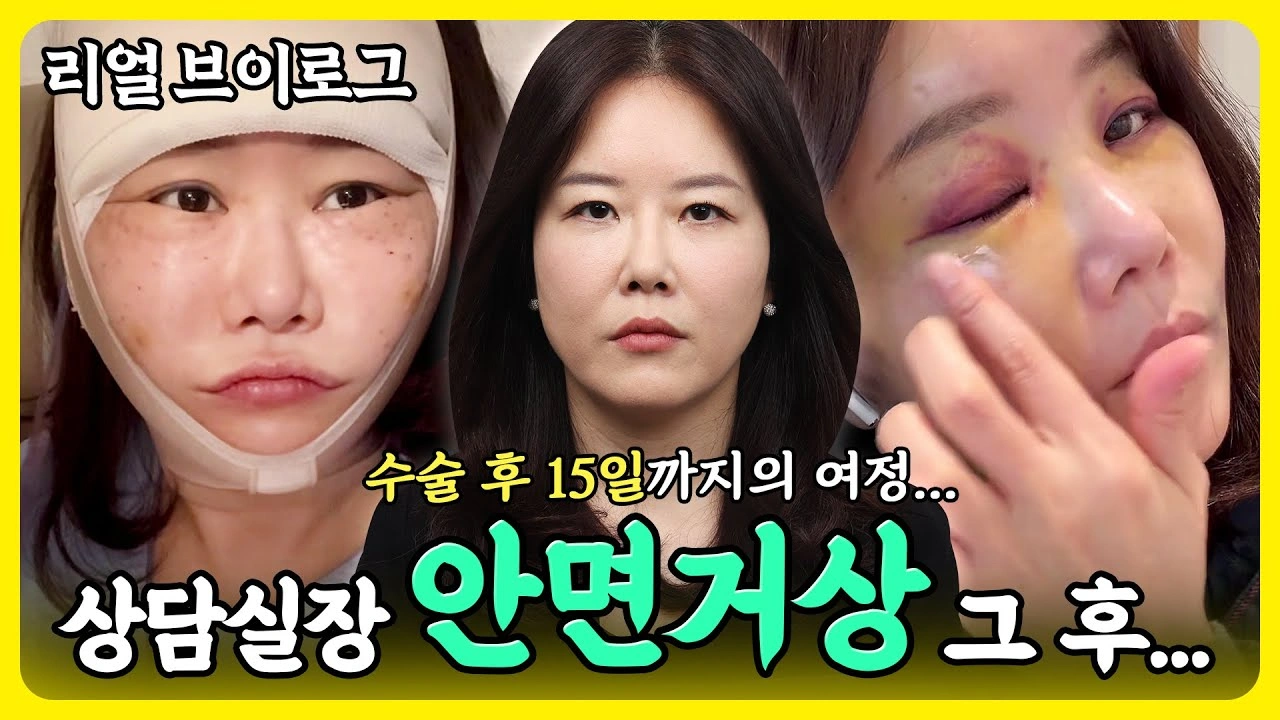 상담실장 안면거상 그 후..