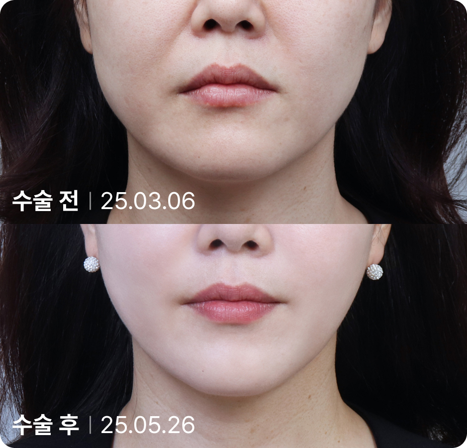 수술 전 | 수술 후
