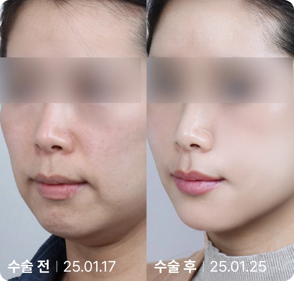 수술 전 | 수술 후