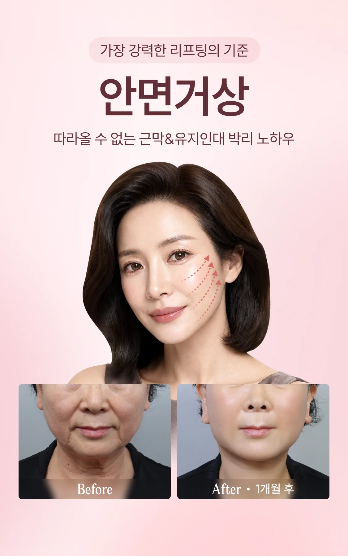 가장 강력한 리프팅의 기준 안면거상